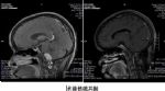饮水呛咳、吞咽困难不当回事？专家提醒：小心是脑瘤！